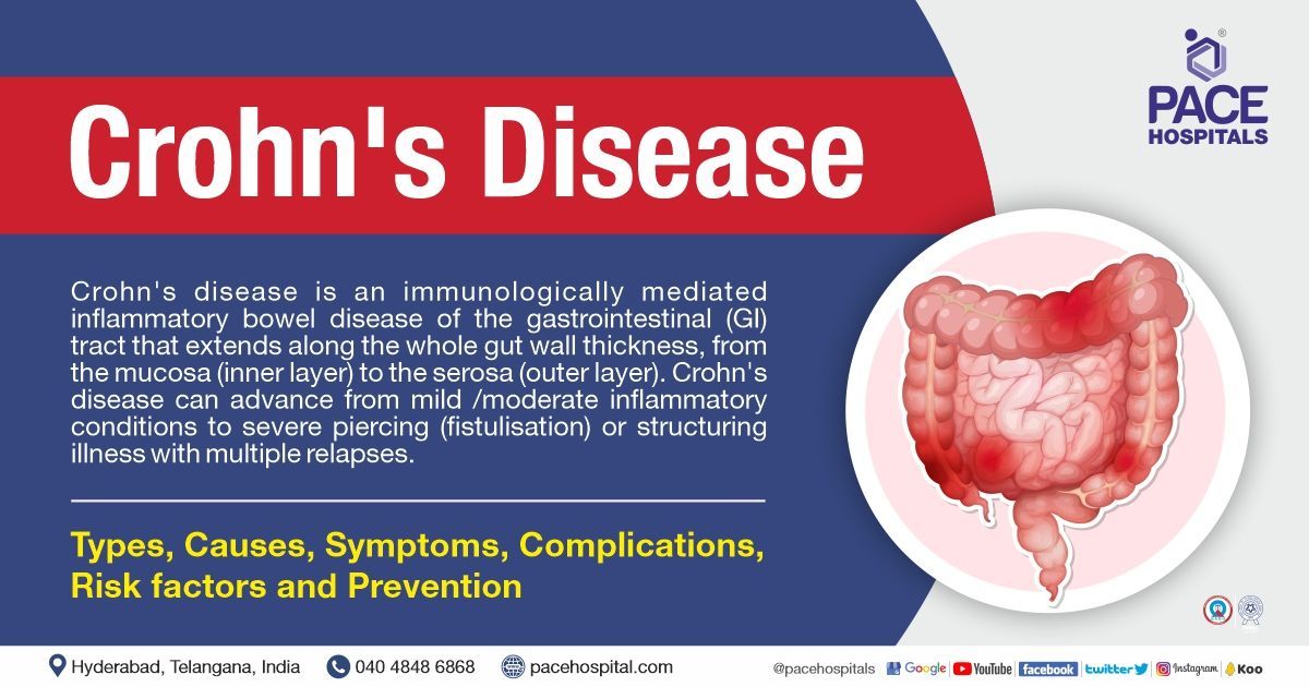 Crohn bmj criteria